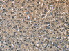 The image on the left is immunohistochemistry of paraffin-embedded Human liver cancer tissue using CSB-PA205920 (ENO1 Antibody) at dilution 1/40, on the right is treated with fusion protein. (Original magnification: ×200)