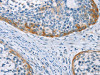 The image on the left is immunohistochemistry of paraffin-embedded Human cervical cancer tissue using CSB-PA210441 (C3AR1 Antibody) at dilution 1/25, on the right is treated with fusion protein. (Original magnification: ×200)