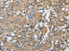 The image on the left is immunohistochemistry of paraffin-embedded Human thyroid cancer tissue using CSB-PA796667 (CAB39L Antibody) at dilution 1/40, on the right is treated with fusion protein. (Original magnification: ×200)
