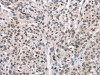 The image on the left is immunohistochemistry of paraffin-embedded Human esophagus cancer tissue using CSB-PA904720 (CABLES1 Antibody) at dilution 1/15, on the right is treated with fusion protein. (Original magnification: ×200)