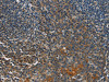 The image on the left is immunohistochemistry of paraffin-embedded Human tonsil tissue using CSB-PA224156 (CACNB1 Antibody) at dilution 1/50, on the right is treated with fusion protein. (Original magnification: ×200)