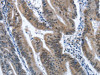 The image on the left is immunohistochemistry of paraffin-embedded Human colon cancer tissue using CSB-PA130108 (CADM3 Antibody) at dilution 1/40, on the right is treated with fusion protein. (Original magnification: ×200)