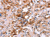 The image on the left is immunohistochemistry of paraffin-embedded Human thyroid cancer tissue using CSB-PA221830 (CALB1 Antibody) at dilution 1/60, on the right is treated with fusion protein. (Original magnification: ×200)