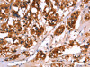 The image on the left is immunohistochemistry of paraffin-embedded Human thyroid cancer tissue using CSB-PA213286 (CALB1 Antibody) at dilution 1/50, on the right is treated with fusion protein. (Original magnification: ×200)