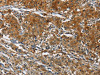 The image on the left is immunohistochemistry of paraffin-embedded Human gastic cancer tissue using CSB-PA597777 (CAST Antibody) at dilution 1/70, on the right is treated with fusion protein. (Original magnification: ×200)