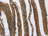 The image on the left is immunohistochemistry of paraffin-embedded Human colon cancer tissue using CSB-PA597777 (CAST Antibody) at dilution 1/70, on the right is treated with fusion protein. (Original magnification: ×200)