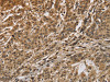 The image is immunohistochemistry of paraffin-embedded Human gastric cancer tissue using CSB-PA987034 (CALU Antibody) at dilution 1/40. (Original magnification: ×200)