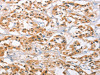 The image on the left is immunohistochemistry of paraffin-embedded Human thyroid cancer tissue using CSB-PA223262 (CAMK4 Antibody) at dilution 1/20, on the right is treated with fusion protein. (Original magnification: ×200)