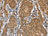 The image on the left is immunohistochemistry of paraffin-embedded Human gastric cancer tissue using CSB-PA942303 (CAT Antibody) at dilution 1/40, on the right is treated with fusion protein. (Original magnification: ×200)
