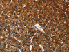 The image on the left is immunohistochemistry of paraffin-embedded Human liver cancer tissue using CSB-PA447681 (CATSPER4 Antibody) at dilution 1/50, on the right is treated with fusion protein. (Original magnification: ×200)