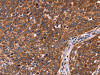 The image on the left is immunohistochemistry of paraffin-embedded Human cervical cancer tissue using CSB-PA520696 (CCDC106 Antibody) at dilution 1/60, on the right is treated with fusion protein. (Original magnification: ×200)