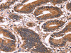 The image on the left is immunohistochemistry of paraffin-embedded Human colon cancer tissue using CSB-PA520696 (CCDC106 Antibody) at dilution 1/60, on the right is treated with fusion protein. (Original magnification: ×200)
