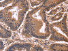 The image on the left is immunohistochemistry of paraffin-embedded Human colon cancer tissue using CSB-PA965050 (CCDC106 Antibody) at dilution 1/50, on the right is treated with fusion protein. (Original magnification: ×200)
