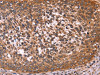 The image on the left is immunohistochemistry of paraffin-embedded Human cervical cancer tissue using CSB-PA965050 (CCDC106 Antibody) at dilution 1/50, on the right is treated with fusion protein. (Original magnification: ×200)