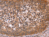 The image on the left is immunohistochemistry of paraffin-embedded Human cervical cancer tissue using CSB-PA965050 (CCDC106 Antibody) at dilution 1/50, on the right is treated with fusion protein. (Original magnification: ×200) The image on the left is immunohistochemistry of paraffin-embedded Human cervical cancer tissue using CSB-PA965050 (CCDC106 Antibody) at dilution 1/50, on the right is treated with fusion protein. (Original magnification: ×200)