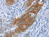 The image on the left is immunohistochemistry of paraffin-embedded Human esophagus cancer tissue using CSB-PA035070 (CCR9 Antibody) at dilution 1/60, on the right is treated with fusion protein. (Original magnification: ×200)