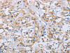 The image on the left is immunohistochemistry of paraffin-embedded Human thyroid cancer tissue using CSB-PA035070 (CCR9 Antibody) at dilution 1/60, on the right is treated with fusion protein. (Original magnification: ×200)