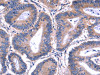 The image on the left is immunohistochemistry of paraffin-embedded Human colon cancer tissue using CSB-PA297000 (PVR Antibody) at dilution 1/20, on the right is treated with fusion protein. (Original magnification: ×200)
