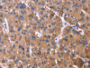 The image on the left is immunohistochemistry of paraffin-embedded Human liver cancer tissue using CSB-PA205578 (KIR2DL3/KIR2DL1/KIR2DL4/KIR2DS4 Antibody) at dilution 1/40, on the right is treated with fusion protein. (Original magnification: ×200)