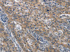 The image on the left is immunohistochemistry of paraffin-embedded Human gastric cancer tissue using CSB-PA787597 (CD160 Antibody) at dilution 1/30, on the right is treated with fusion protein. (Original magnification: ×200)