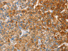 The image on the left is immunohistochemistry of paraffin-embedded Human liver cancer tissue using CSB-PA903031 (CD200R1 Antibody) at dilution 1/60, on the right is treated with fusion protein. (Original magnification: ×200)