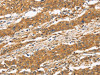 The image on the left is immunohistochemistry of paraffin-embedded Human gastic cancer tissue using CSB-PA616669 (CD22 Antibody) at dilution 1/50, on the right is treated with fusion protein. (Original magnification: ×200)