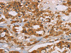 The image on the left is immunohistochemistry of paraffin-embedded Human thyroid cancer tissue using CSB-PA576542 (CD22 Antibody) at dilution 1/50, on the right is treated with fusion protein. (Original magnification: ×200)