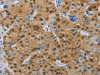 The image on the left is immunohistochemistry of paraffin-embedded Human liver cancer tissue using CSB-PA100659 (BTLA Antibody) at dilution 1/30, on the right is treated with fusion protein. (Original magnification: ×200)