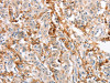 The image on the left is immunohistochemistry of paraffin-embedded Human gastric cancer tissue using CSB-PA617106 (SIGLEC9 Antibody) at dilution 1/30, on the right is treated with fusion protein. (Original magnification: ×200)