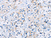 The image on the left is immunohistochemistry of paraffin-embedded Human thyroid cancer tissue using CSB-PA070366 (CD33 Antibody) at dilution 1/30, on the right is treated with fusion protein. (Original magnification: ×200)