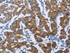 The image on the left is immunohistochemistry of paraffin-embedded Human breast cancer tissue using CSB-PA899163 (NCR3 Antibody) at dilution 1/40, on the right is treated with fusion protein. (Original magnification: ×200)