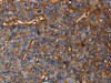 The image on the left is immunohistochemistry of paraffin-embedded Human liver cancer tissue using CSB-PA930156 (CD46 Antibody) at dilution 1/30, on the right is treated with fusion protein. (Original magnification: ×200)