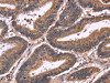 The image on the left is immunohistochemistry of paraffin-embedded Human colon cancer tissue using CSB-PA282707 (SEPT7 Antibody) at dilution 1/60, on the right is treated with fusion protein. (Original magnification: ×200)