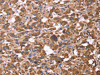 The image on the left is immunohistochemistry of paraffin-embedded Human thyroid cancer tissue using CSB-PA623964 (FBXW7 Antibody) at dilution 1/30, on the right is treated with fusion protein. (Original magnification: ×200)