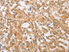 The image on the left is immunohistochemistry of paraffin-embedded Human thyroid cancer tissue using CSB-PA644111 (CDKN2C Antibody) at dilution 1/25, on the right is treated with fusion protein. (Original magnification: ×200)