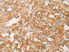 The image on the left is immunohistochemistry of paraffin-embedded Human thyroid cancer tissue using CSB-PA075339 (CDKN2C Antibody) at dilution 1/25, on the right is treated with fusion protein. (Original magnification: ×200)