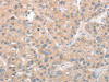 The image on the left is immunohistochemistry of paraffin-embedded Human liver cancer tissue using CSB-PA075339 (CDKN2C Antibody) at dilution 1/25, on the right is treated with fusion protein. (Original magnification: ×200)