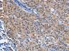 The image on the left is immunohistochemistry of paraffin-embedded Human gastic cancer tissue using CSB-PA438445 (CDO1 Antibody) at dilution 1/40, on the right is treated with fusion protein. (Original magnification: ×200)