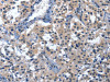 The image on the left is immunohistochemistry of paraffin-embedded Human thyroid cancer tissue using CSB-PA438445 (CDO1 Antibody) at dilution 1/40, on the right is treated with fusion protein. (Original magnification: ×200)