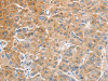 The image on the left is immunohistochemistry of paraffin-embedded Human liver cancer tissue using CSB-PA073505 (CDR2 Antibody) at dilution 1/60, on the right is treated with fusion protein. (Original magnification: ×200)