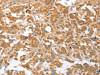 The image on the left is immunohistochemistry of paraffin-embedded Human thyroid cancer tissue using CSB-PA283856 (CDR2 Antibody) at dilution 1/30, on the right is treated with fusion protein. (Original magnification: ×200)