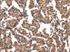 The image on the left is immunohistochemistry of paraffin-embedded Human breast cancer tissue using CSB-PA292680 (CGA Antibody) at dilution 1/65, on the right is treated with fusion protein. (Original magnification: ×200)