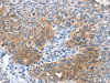 The image on the left is immunohistochemistry of paraffin-embedded Human ovarian cancer tissue using CSB-PA030984 (CGB Antibody) at dilution 1/60, on the right is treated with fusion protein. (Original magnification: ×200)