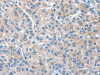 The image on the left is immunohistochemistry of paraffin-embedded Human liver cancer tissue using CSB-PA990883 (CGB Antibody) at dilution 1/40, on the right is treated with fusion protein. (Original magnification: ×200)