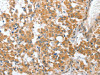 The image on the left is immunohistochemistry of paraffin-embedded Human thyroid cancer tissue using CSB-PA078194 (CHMP4B Antibody) at dilution 1/40, on the right is treated with fusion protein. (Original magnification: ×200)