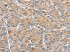 The image on the left is immunohistochemistry of paraffin-embedded Human liver cancer tissue using CSB-PA078194 (CHMP4B Antibody) at dilution 1/40, on the right is treated with fusion protein. (Original magnification: ×200)