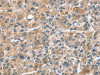 The image on the left is immunohistochemistry of paraffin-embedded Human liver cancer tissue using CSB-PA174578 (CHMP4B Antibody) at dilution 1/40, on the right is treated with fusion protein. (Original magnification: ×200)