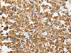 The image on the left is immunohistochemistry of paraffin-embedded Human thyroid cancer tissue using CSB-PA174578 (CHMP4B Antibody) at dilution 1/40, on the right is treated with fusion protein. (Original magnification: ×200)