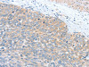 The image on the left is immunohistochemistry of paraffin-embedded Human cervical cancer tissue using CSB-PA796998 (WNT3A Antibody) at dilution 1/40, on the right is treated with fusion protein. (Original magnification: ×200)