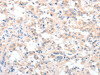 The image on the left is immunohistochemistry of paraffin-embedded Human thyroid cancer tissue using CSB-PA087998 (CIDEC Antibody) at dilution 1/30, on the right is treated with fusion protein. (Original magnification: ×200)